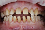 Fig 6. Final preparations for anterior veneers and posterior crowns. Note that much of the anterior teeth were in enamel, which aids bond strength.