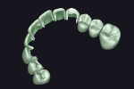 Fig 8. Final digital design of the maxillary arch of crowns and veneers using exocad digital planning software (exocad).