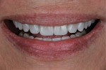 Fig 11. The patient’s final smile. Note the fuller smile with a wider buccal corridor that was now more even on both sides. Also, the incisal edges follow the lower lip line form.