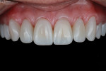 Fig 12. Final maxillary restorations with proper line angle development and all diastemas eliminated. Restorations were delivered only 1 week prior.