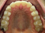 Fig 4. Pretreatment, upper dentition, occlusal view.