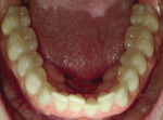 Fig 5. Pretreatment, lower dentition, occlusal view.