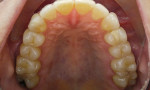 Fig 8. At 7 months, upper dentition, occlusal view.
