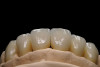 Figure 1  Initial presentation with yellow, poorly color-matched restored mandibular anterior teeth.
