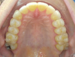 Fig 13. At 11.5 months, upper dentition, occlusal view.