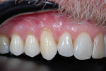 Fig 3. Preoperative, right lateral view showing gingival recession at teeth Nos. 5 and 6.