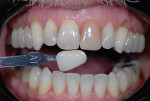 Fig 5. The A1 shade tab most closely matched the patient’s dentition.