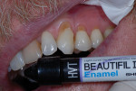 Fig 6. The clinician used Beautifil II Enamel composite for this direct esthetic restoration because of its excellent blend capabilities, offering a beautiful chameleon effect and the right amount of translucency and opacity to block out the yellow root portion of the tooth. The nanohybrid composite material also offers superb handling.