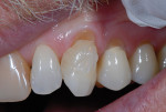 Fig 7. The clinician generally chooses the shades and tries them in first by placing the composite on the tooth, followed by light-curing. This allows visualization of which shade or blending of shades that will lead to the patient's desired outcome, before etching and bonding.