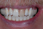 Fig 8. Postoperative, frontal view of the upper cuspid and bicuspid gingival margin restorations. The patient wanted the gingival margins whiter than the clinician would have preferred; however, the color blend is visually acceptable. The patient was pleased and plans on having tooth No. 9 restored next year due to financial limitations.