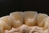 Figure 3  Shade selection for final crowns, teeth Nos. 22 through 28; post-extraction of No. 26 and decoronation of Nos. 24 and 25; Nos. 22, 23, 27, and 28 prepared for full coverage.
