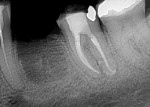 Fig 8. One-month postoperative follow-up radiograph.