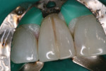 Fig 3. Preparation of the tooth revealed deeply colored but noncarious dentin.