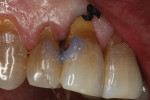 Fig 9. A Mylar strip was used to protect the adjacent tooth while selective etching of enamel was accomplished.