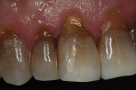 Fig 12 and Fig 13. After finishing and polishing, the OMNICHROMA material demonstrated its ability to match its surroundings, even though they ranged from light to dark in the same tooth.