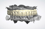 Fig 3. The data from the scans was digitally transferred to the laboratory (Absolute Dental Services) along with detailed instructions for creating a digital wax-up and designing the definitive zirconia prosthesis. Retentive recesses were planned in the prosthesis to accomplish the chairside pick-up of the LOCATOR FIXED housings.