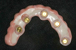 Fig 9. The LOCATOR FIXED housings were picked up in the prosthesis. The black processing inserts were removed, excess resin was eliminated, and the prosthesis was adjusted, finished, and polished as needed.