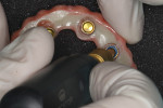 Fig 10 and Fig 11. Appropriate LOCATOR FIXED inserts were placed into the housings with the Enhanced Core Tool (Zest Dental Solutions) (Fig 10), which was also used to press the inserts down firmly until they snapped into place (Fig 11).
