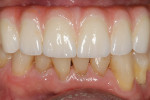 Fig 13. Definitive LOCATOR FIXED zirconia prosthesis placed in the mouth.