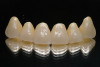 Figure 7  Finished feldspathic crowns, teeth Nos. 22, 23, 27, 28, and implant sites 24 through 26 showing good gingival emergence profile—post-cementation facial view.