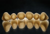Figure 8  Full smile—finished feldspathic crowns on teeth Nos. 22, 23, 27, and 28; implant crowns in sites 24 through 26; esthetic harmonization with opposing dentition.