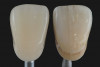 Figure 21  Screw access of final zirconia crown sealed with composite resin—incisal view.
