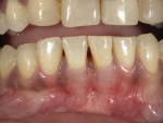 (1. AND 2.) Before and after images of gingival recession affecting teeth Nos. 24 and 25 that was restored with Beautifil II Gingiva (Images provided by Paiman Lalla, DDS).