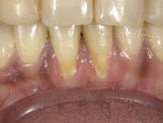 (1. AND 2.) Before and after images of gingival recession affecting teeth Nos. 24 and 25 that was restored with Beautifil II Gingiva (Images provided by Paiman Lalla, DDS).
