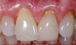 (3. AND 4.) Before and after images of gingival recession affecting teeth Nos. 8 through 10 that was restored with Beautifil II Gingiva (Images provided by Victor Ortiz, DDS).