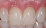 (3. AND 4.) Before and after images of gingival recession affecting teeth Nos. 8 through 10 that was restored with Beautifil II Gingiva (Images provided by Victor Ortiz, DDS).