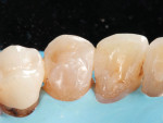 (2.) Follow-up photograph of the root caries on the palatal aspect of tooth No. 5 acquired 6 months after the first application of a 38% SDF solution.
