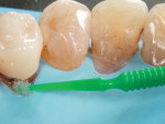 (3.) A second application of 38% SDF solution was placed on the palatal aspect of tooth No. 5 under rubber dam isolation. Note that the SDF exhibits a blueish hue from a tint that is added by the manufacturer to enhance its visibility.