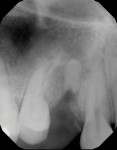 (1.) Periapical radiograph of a patient who presented with a hopeless tooth No. 5. The tooth was extracted, and a socket preservation procedure was performed.