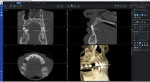 (2.) A CBCT scan (Planmeca ProMax® 3D Classic, Planmeca) was acquired.