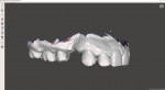 (3.) An intraoral scan (Aoralscan 3, Shining 3D Dental) was acquired and viewed in planning software (Meshmixer, Autodesk Research).