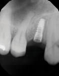 (11.) An immediate postsurgical periapical radiograph was acquired (Gendex™ GXS-700, Dexis) to assess the implant’s placement.