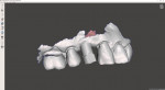 (12.) After approximately 3 months of osseointegration, the implant was uncovered, a digital impression scan body (MOR® Scan Body, Sterngold) was placed, and an intraoral scan was acquired.