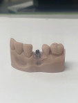 (16.) Buccal view of the titanium base on the model.