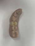 (17.) Occlusal view of the milled (DWX-52D, Roland DGA Corporation) final zirconia restoration on the model.
