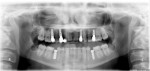 Figure 32  Panoramic radiograph, final restorations in place.