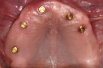 Fig 1. The maxillary arch had five existing implants with LOCATOR abutments that were used to support and retain a removable implant prosthesis. The number and position of the implants, esthetics, occlusal vertical dimension, and occlusion established with the existing prosthesis were acceptable.