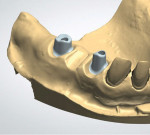 (9.) Digital design of the abutments to fit the adjusted soft-tissue model.