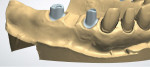 (10.) Digital design of the implant abutments.