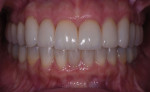 (12.) A close-up view of the teeth in maximum intercuspation post-treatment.