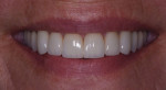 (13.) A close-up view of the patient’s natural smile after treatment.