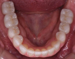 (15.) The mandibular arch post-treatment.
