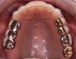 Fig 3. Pretreatment,
occlusal view of maxillary arch.
