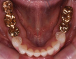 Fig 4.
Pretreatment, occlusal view of mandibular arch.