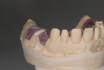 Fig 6 through Fig 8. Model before (Fig 6), during (Fig 7), and after
(Fig 8) adjustment of the soft-tissue material apically to mimic the ideal
tooth length (Nos. 12 through 14) and preparation of the ovate pontic
site.