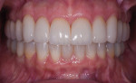 Fig 10. Post-treatment, teeth in maximum intercuspation.